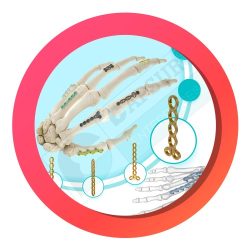 hand-and-foot-implants