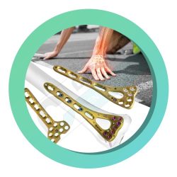 locking-distal-radius-plate